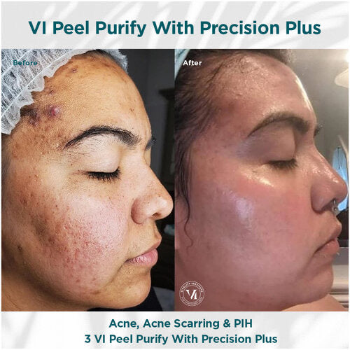 VI Peel Purify with Precision +Peptides Full kit Exp.08/2027