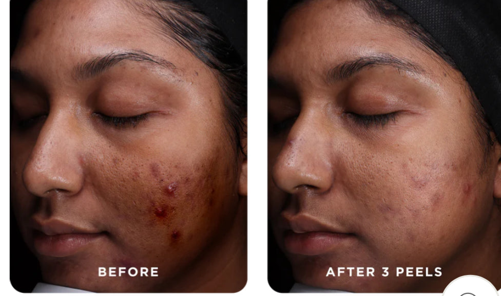 VI Peel Purify with Precision +Peptides Full kit Exp.08/2027